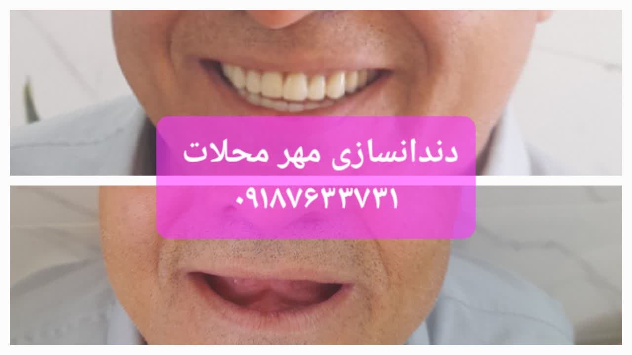 دندانسازی محلات